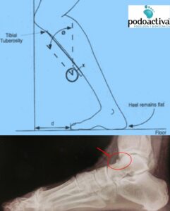 radiografia pie pinzamiento tobillo