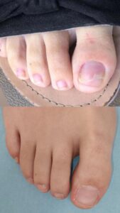 reconstruccion ungueal