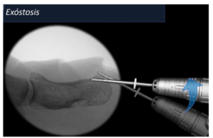 operacion dedo gordo del pie