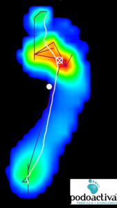 síndrome predislocacion metatarsalgia