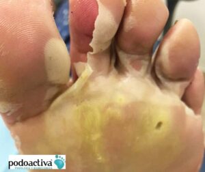 causas de callicidas para curar durezas y callos