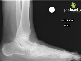 radiografia_ligamento_spring