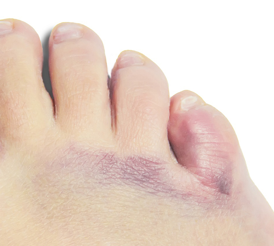 Golpe en el dedo meñique del pie