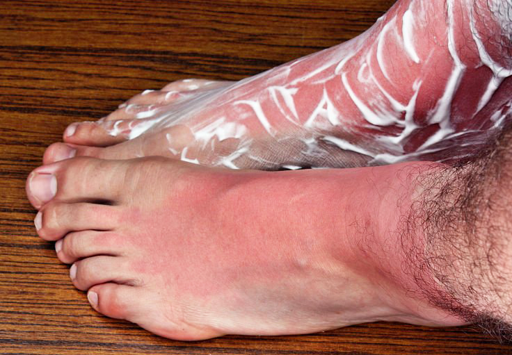 La hidratación de los pies es fundamental.